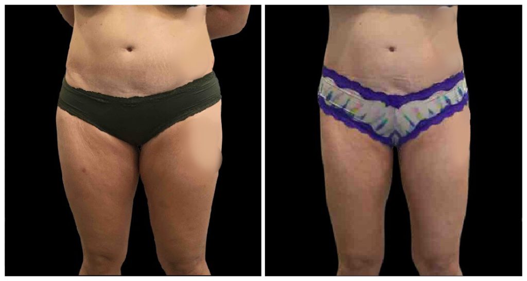 Before and after images of a torso showing changes in body contour and skin appearance following a liposuction procedure.