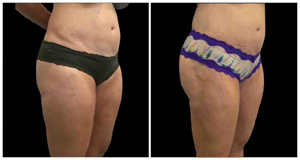Before and after images of a woman's lower body showing changes in contour and skin appearance following a liposuction procedure.