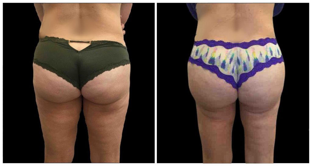 Before and after images showing the posterior view of a person's lower body in different underwear styles.