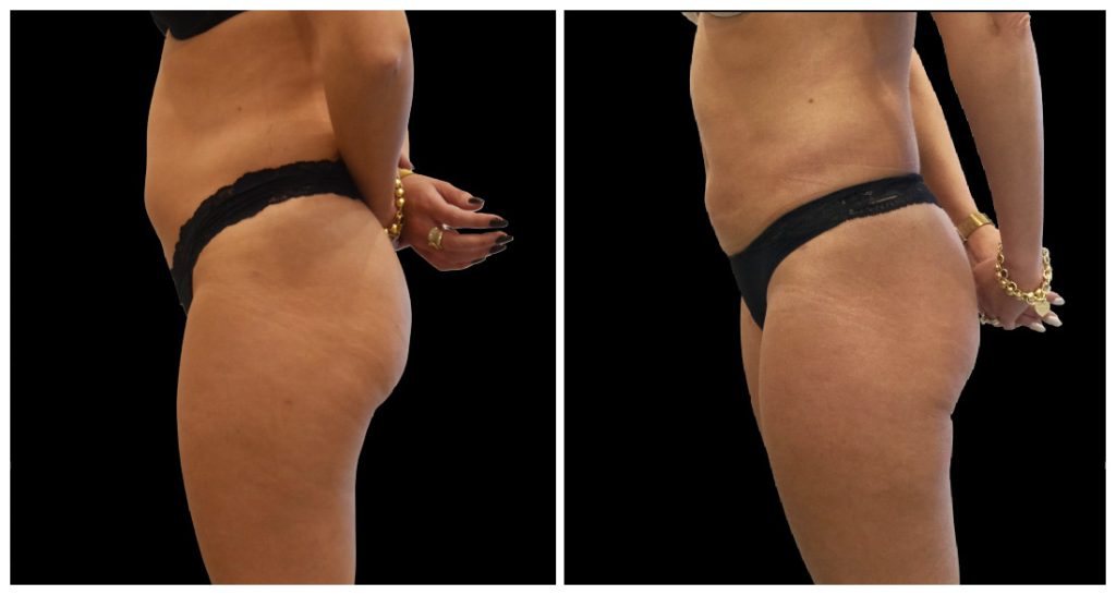 Before and after images of a woman's lateral view showing changes in body contour and skin texture.