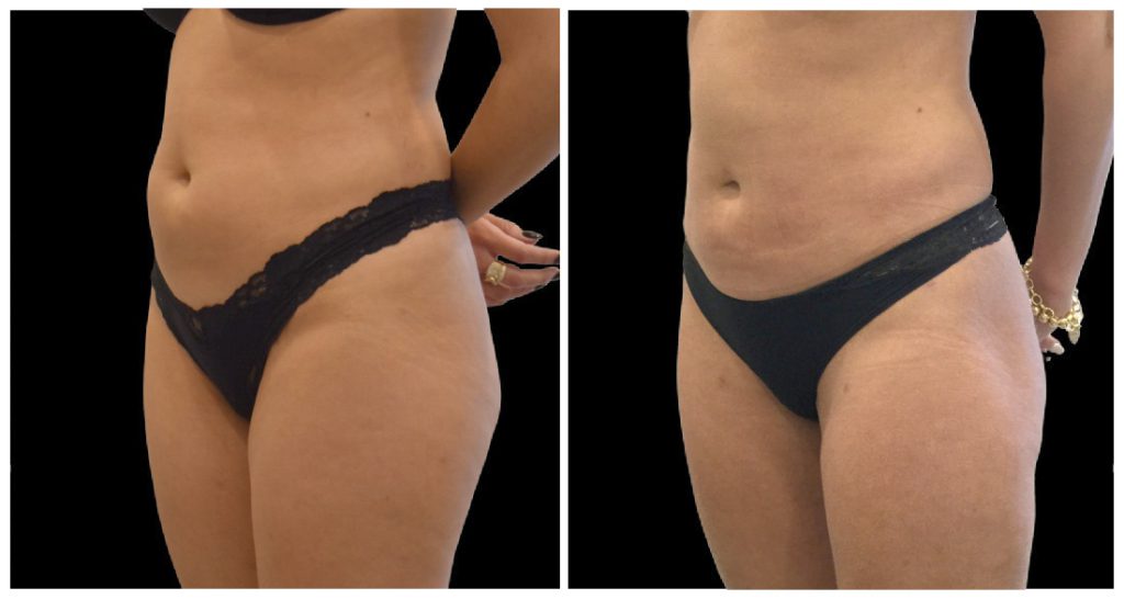 Before and after images of a woman's abdomen and thighs, showcasing changes in body contour and skin appearance.