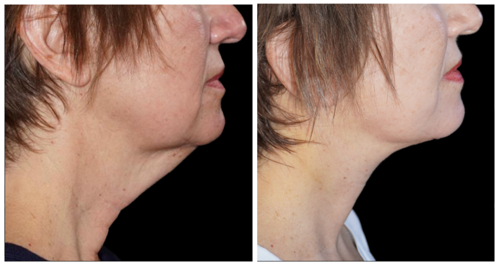 Side profile of a patient at Yazdani Aesthetics in London Ontario, showing a smoother neck contour and defined jawline with light skin and short hair.