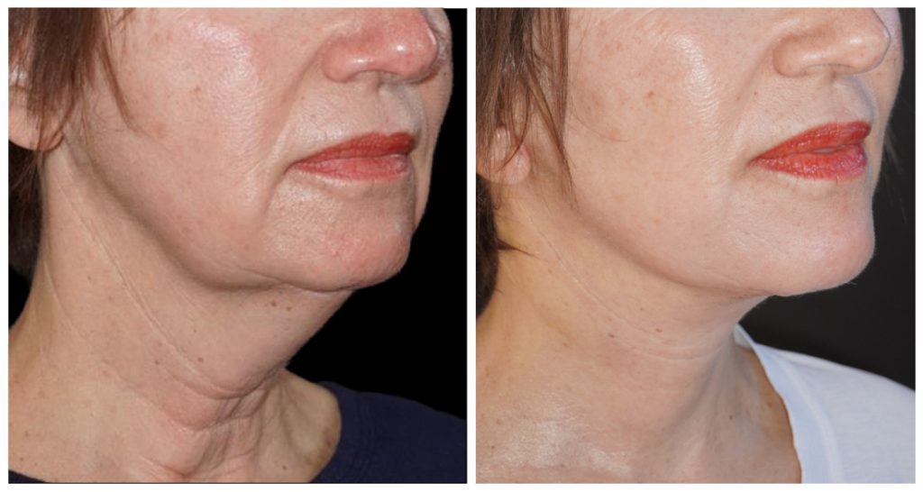 Yazdani Aesthetics neck lift transformation showing tightened neck contour and smoother jawline with improved skin texture in a patient from London Ontario