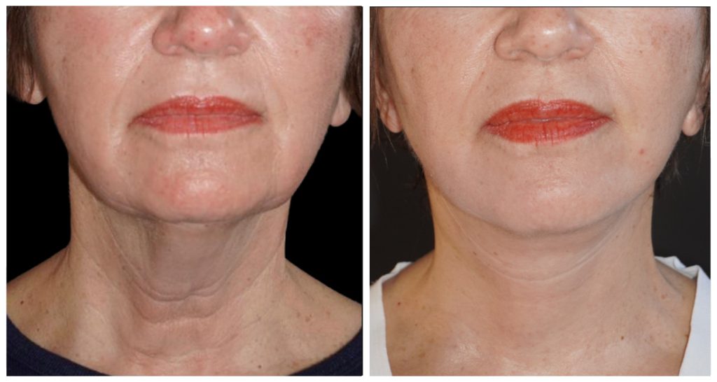 Two-panel close-up of a woman's neck and lower face showing smooth skin and improved contour; Yazdani Aesthetics, London Ontario.