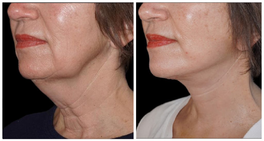 Yazdani Aesthetics neck lift side-by-side profile image showing a contoured jawline and improved neck skin, featuring a woman with red lips and short hair