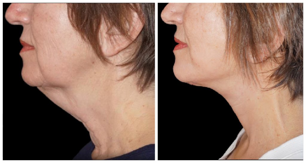 Before and after neck lift at Yazdani Aesthetics in London Ontario, showing a smoother jawline and tightened neck skin with a light complexion and brown hair.