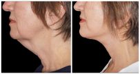 Before and after neck lift at Yazdani Aesthetics in London Ontario, showing a smoother jawline and tightened neck skin with a light complexion and brown hair.