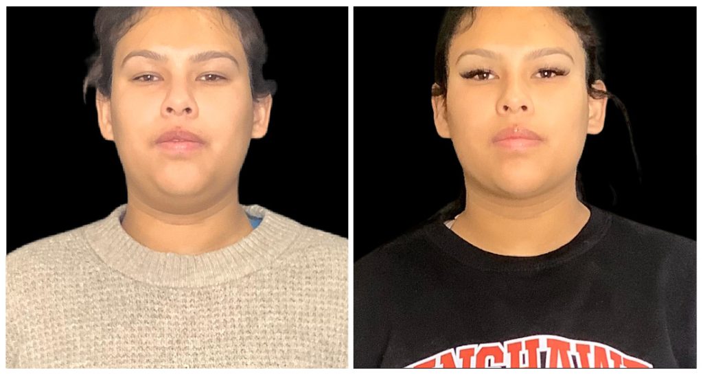 Before and after images of a neck lift procedure showing changes in facial contour and neck appearance.