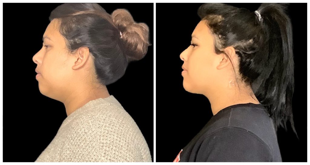 Side profile comparison of a woman with different hairstyles, showcasing a bun on one side and a ponytail on the other.