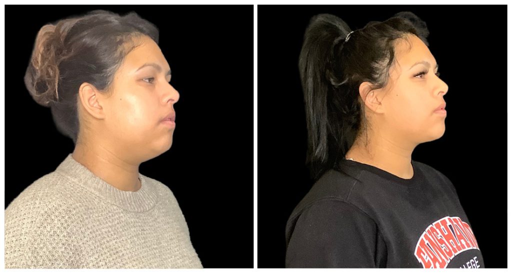 Side profile view of a woman before and after a neck lift procedure, showing changes in neck contour and facial appearance.