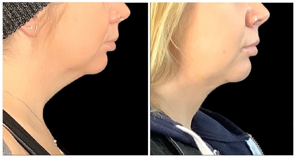 Side-by-side comparison of two women's neck profiles, showing differences in contour and skin appearance.