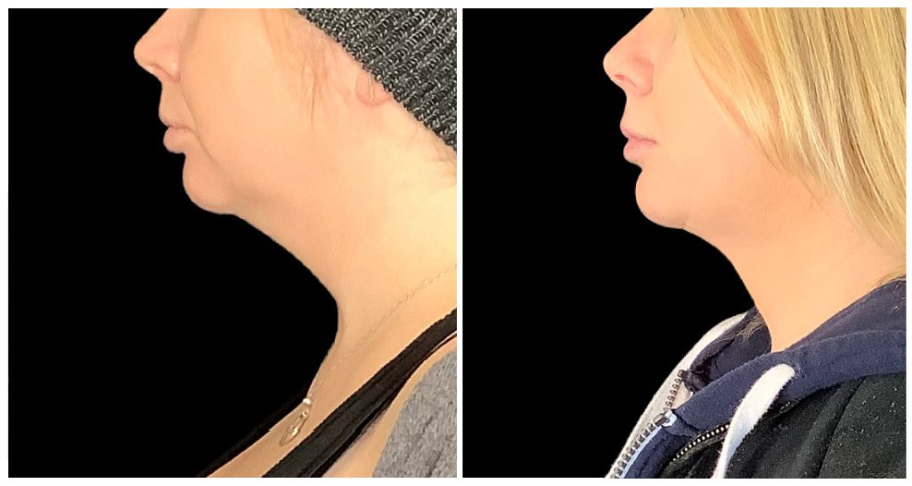 Side profile comparison of two individuals showing different neck contours and jawlines against a black background.