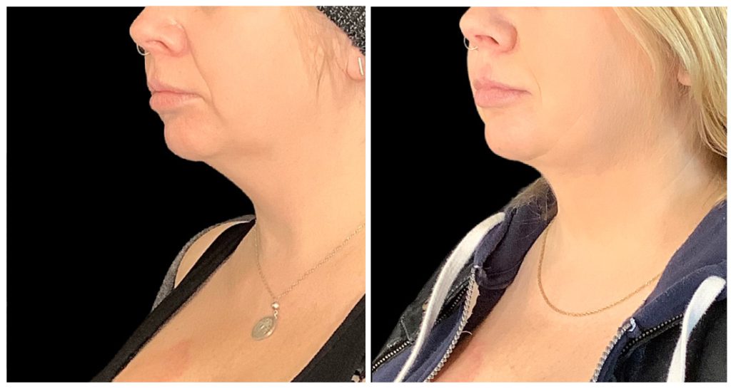 Side profile comparison of two individuals showing neck and jawline appearance, highlighting differences in contour and skin texture.