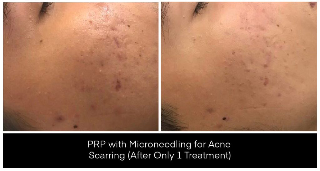Microneedling London Ontario before and after result