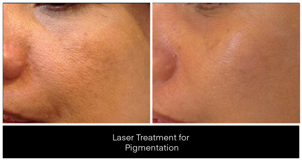 Laser Treatments for Pigmentation before and after result