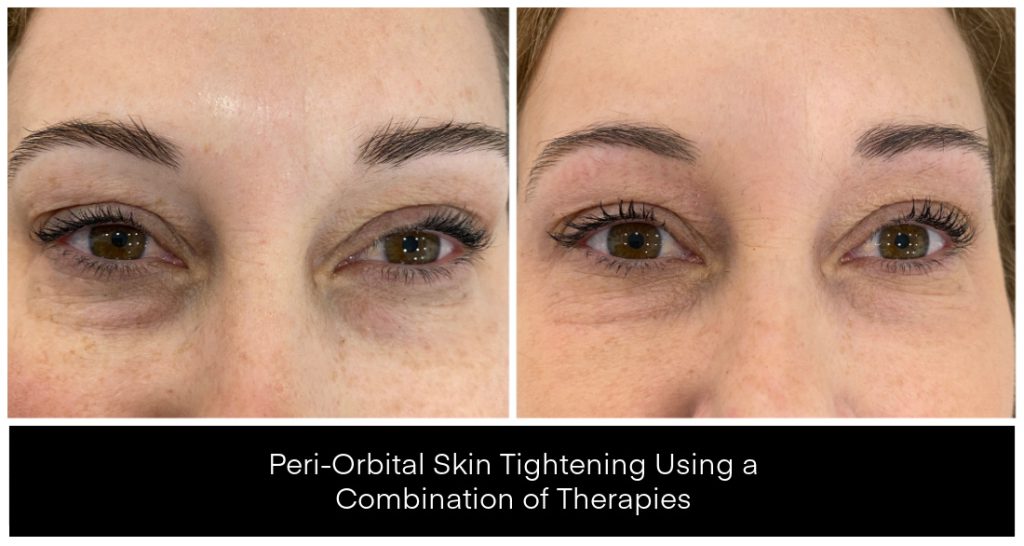 Before and after images of peri-orbital skin tightening treatment showing improved appearance around the eyes.