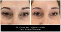 Before and after images of peri-orbital skin tightening treatment showing improved appearance around the eyes.