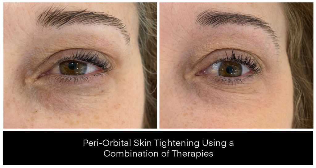 Before and after images showing peri-orbital skin tightening results using a combination of therapies on a woman's eyes.