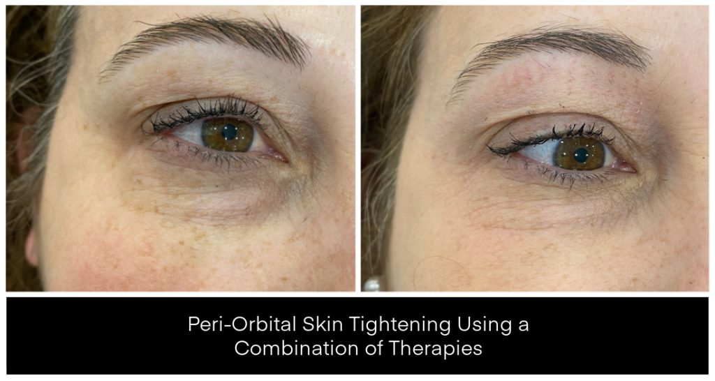 Before and after images showing peri-orbital skin tightening results using a combination of therapies, highlighting changes in skin texture and appearance.