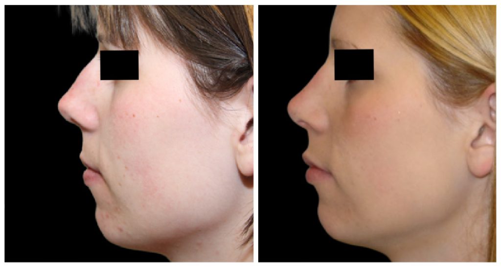 Before and after images of a rhinoplasty procedure showing changes in the nasal profile and facial contours.