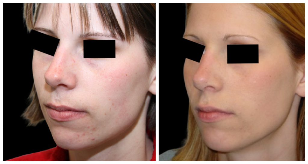 Before and after images of a rhinoplasty procedure showing changes in the nose shape and facial appearance.