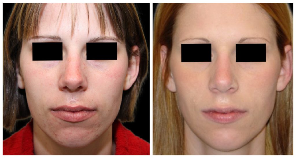 Before and after images of a rhinoplasty procedure showing changes in the nose and facial structure of a patient.