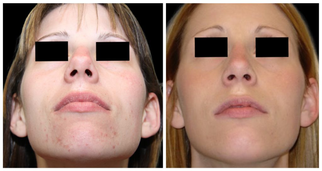 Before and after images of a rhinoplasty procedure showing changes in nasal structure and facial appearance.