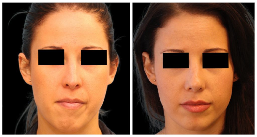 Before and after images of a female patient showing changes in facial appearance following rhinoplasty surgery.
