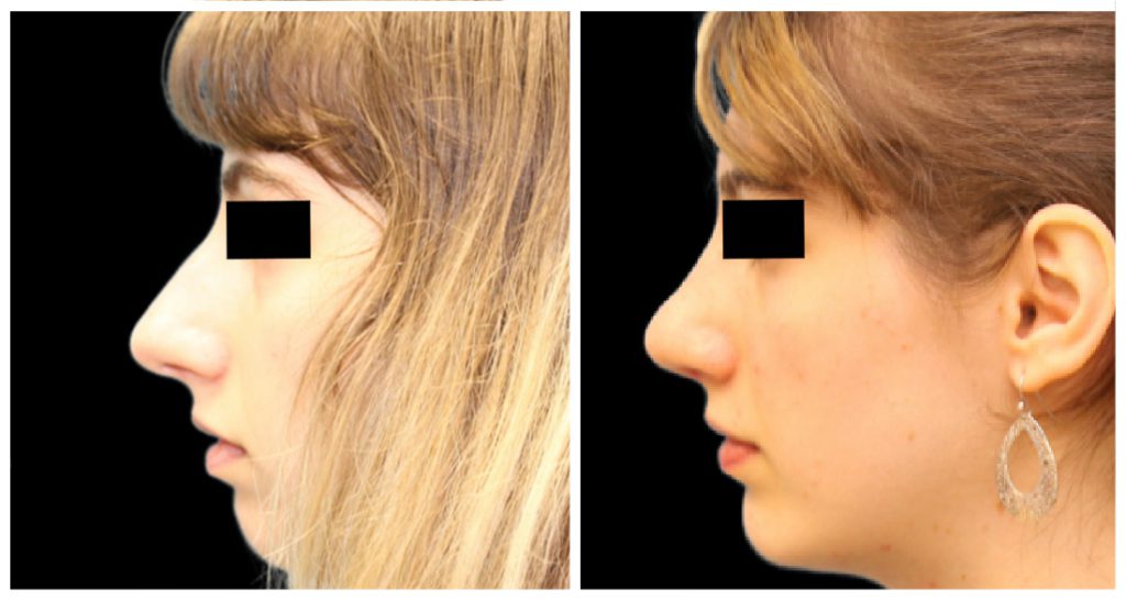 Profile view of a woman's nose before and after rhinoplasty, showing changes in shape and contour.