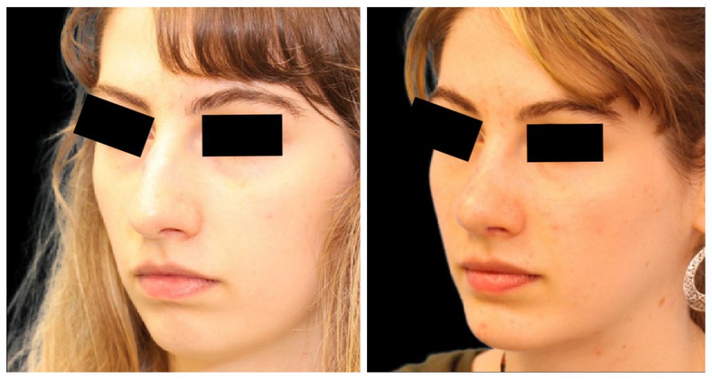 Before and after images of a rhinoplasty procedure showing changes in the nose shape and facial profile of a female patient.