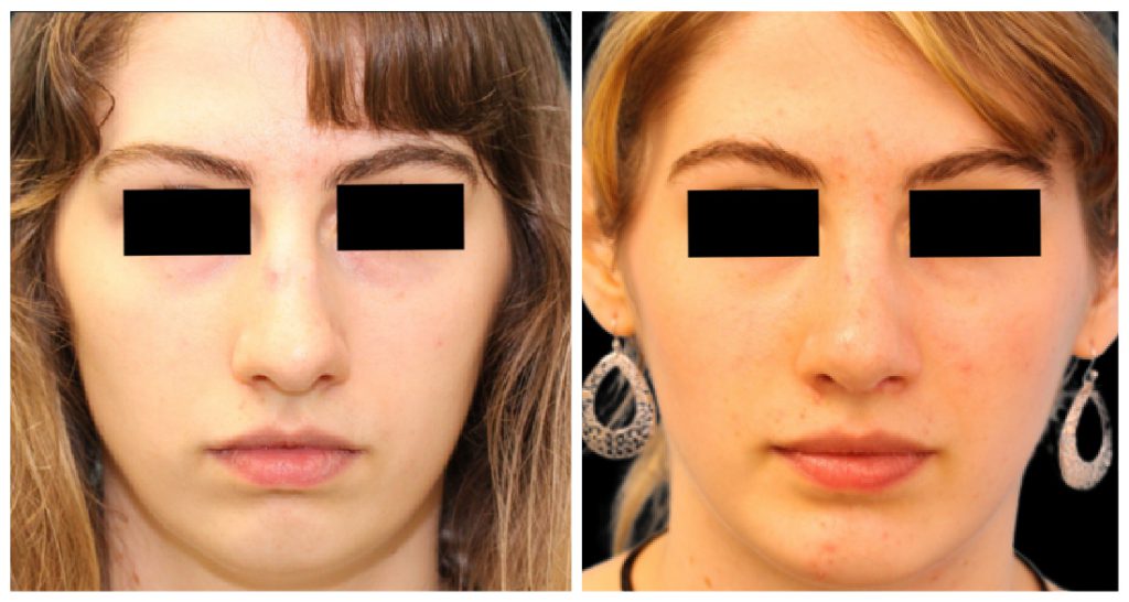 Before and after images of a rhinoplasty procedure showing changes in the nose and facial features of a female patient.