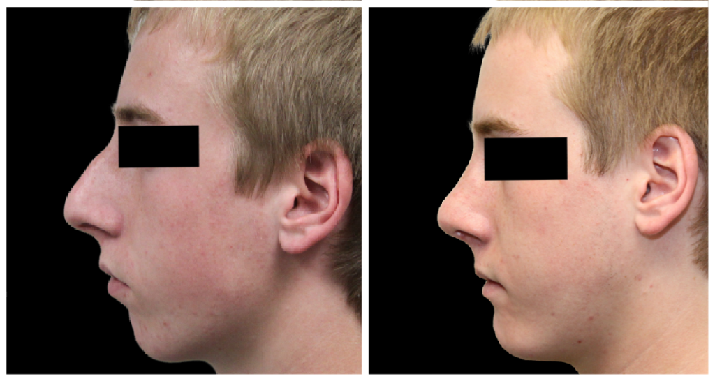 Side profile comparison of a male subject before and after rhinoplasty, showing changes in nasal structure and contour.