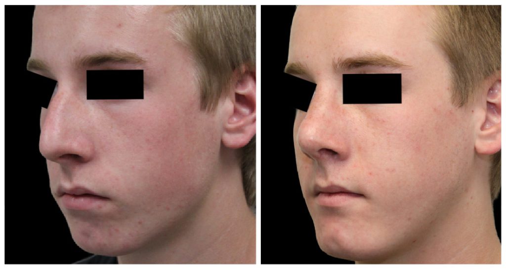 Before and after images of a rhinoplasty procedure showing changes in the nose and facial profile of a young male patient.