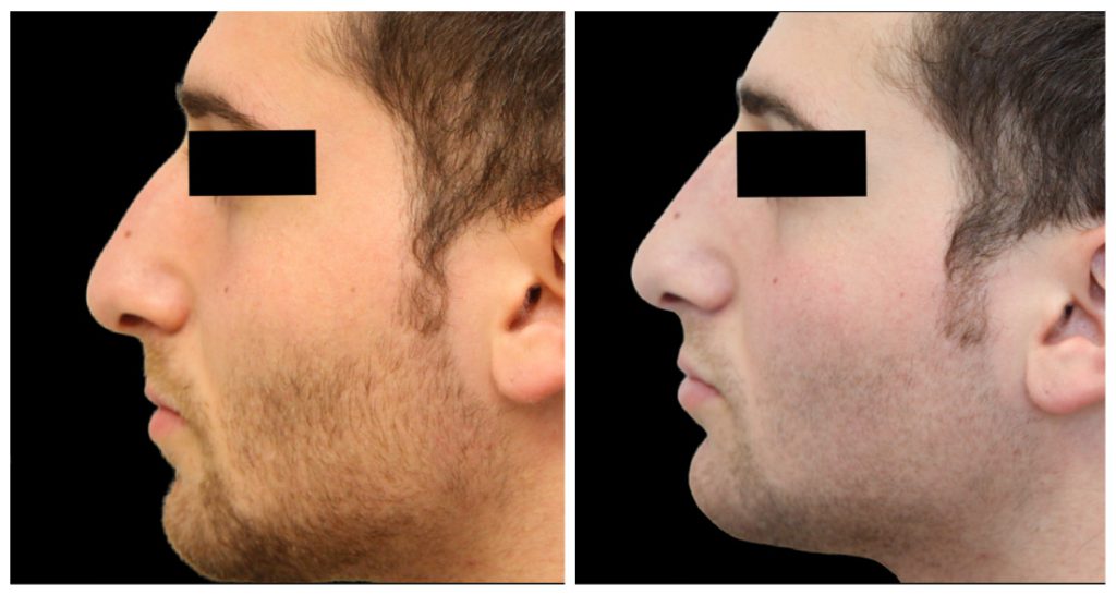 Before and after images of a rhinoplasty procedure showing profile views of a male patient with changes to the nose shape.