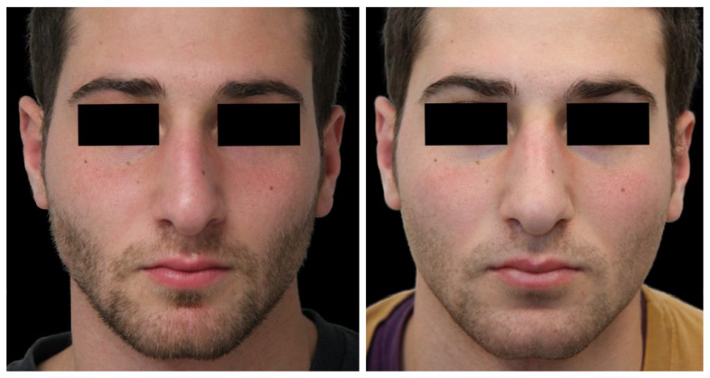 Before and after images of a male patient showing changes in facial structure following rhinoplasty procedure.