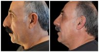 Rhinoplasty in London Ontario before and after result