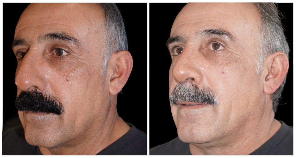 Rhinoplasty in London Ontario before and after result