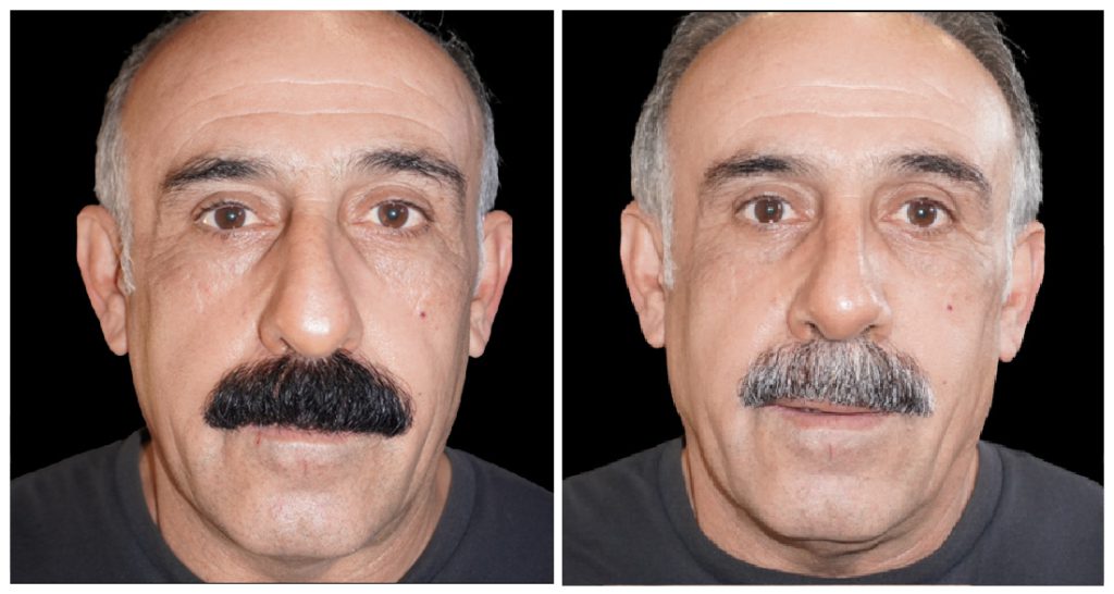 Rhinoplasty in London Ontario before and after result
