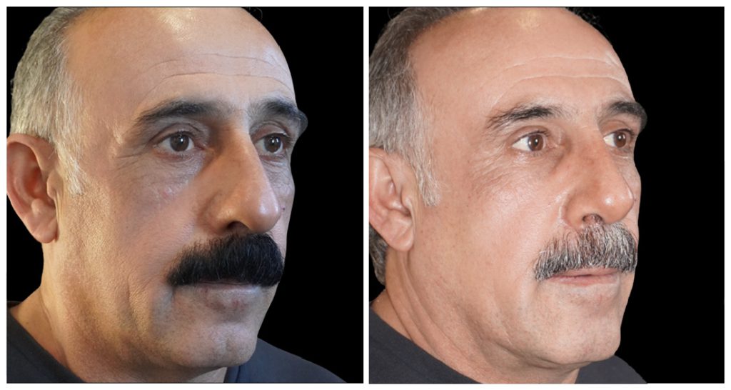 Rhinoplasty in London Ontario before and after result