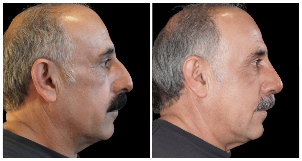 Rhinoplasty in London Ontario before and after result