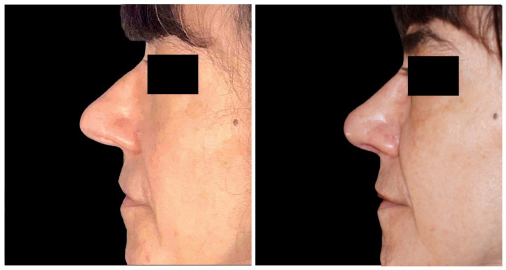 Rhinoplasty in London Ontario before and after result