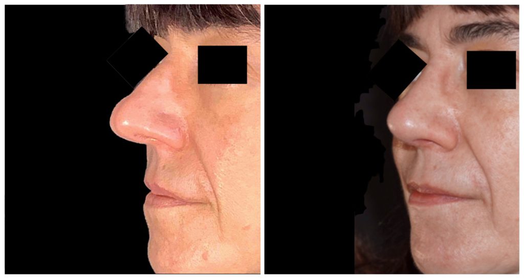 Rhinoplasty in London Ontario before and after result