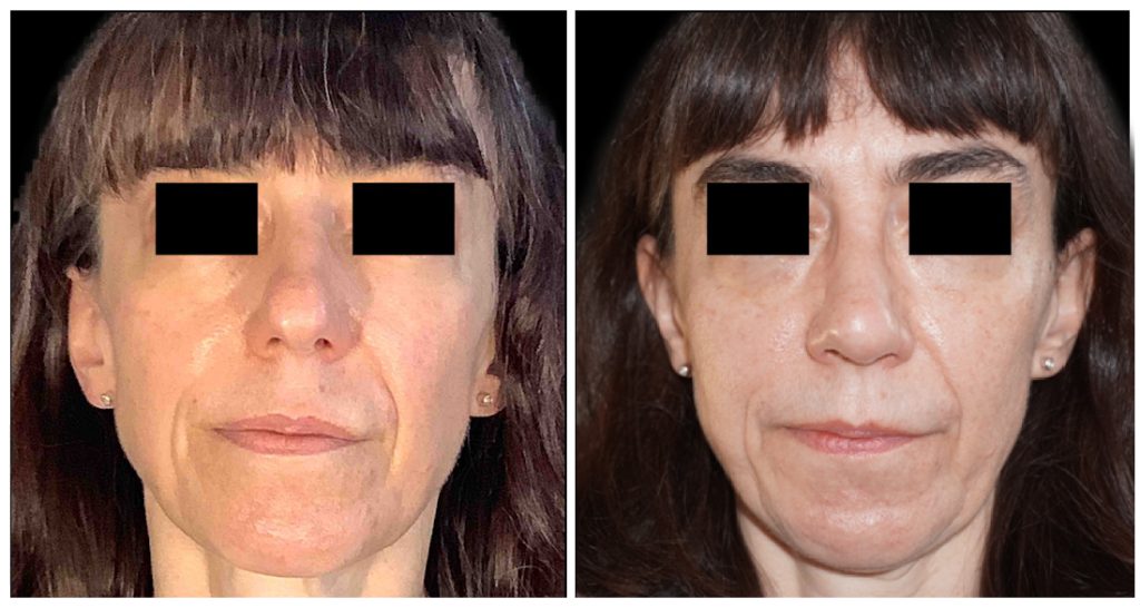 Rhinoplasty in London Ontario before and after result