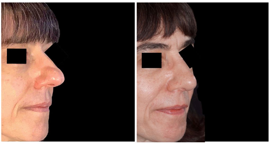 Rhinoplasty in London Ontario before and after result