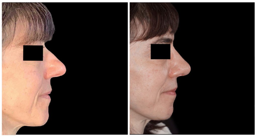 Rhinoplasty in London Ontario before and after result