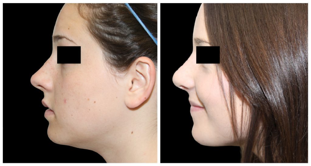 Before and after images of a rhinoplasty procedure showing profile views of a woman's nose and facial structure.