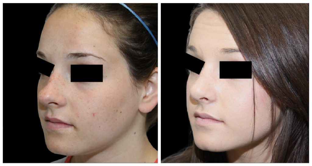 Before and after images of a rhinoplasty procedure showing changes in the nose shape and facial profile of a female patient.