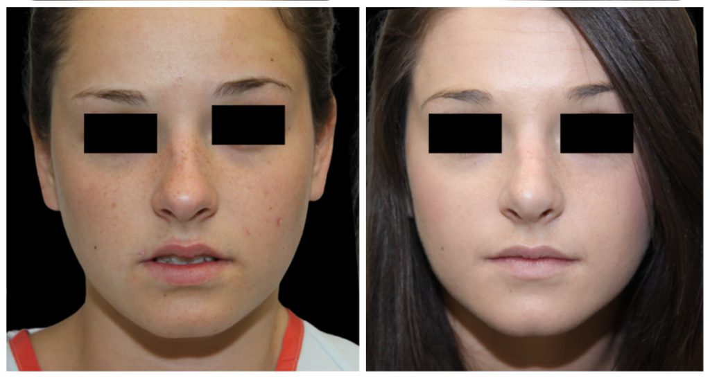 Before and after images of a rhinoplasty procedure showing changes in the nose and facial appearance.