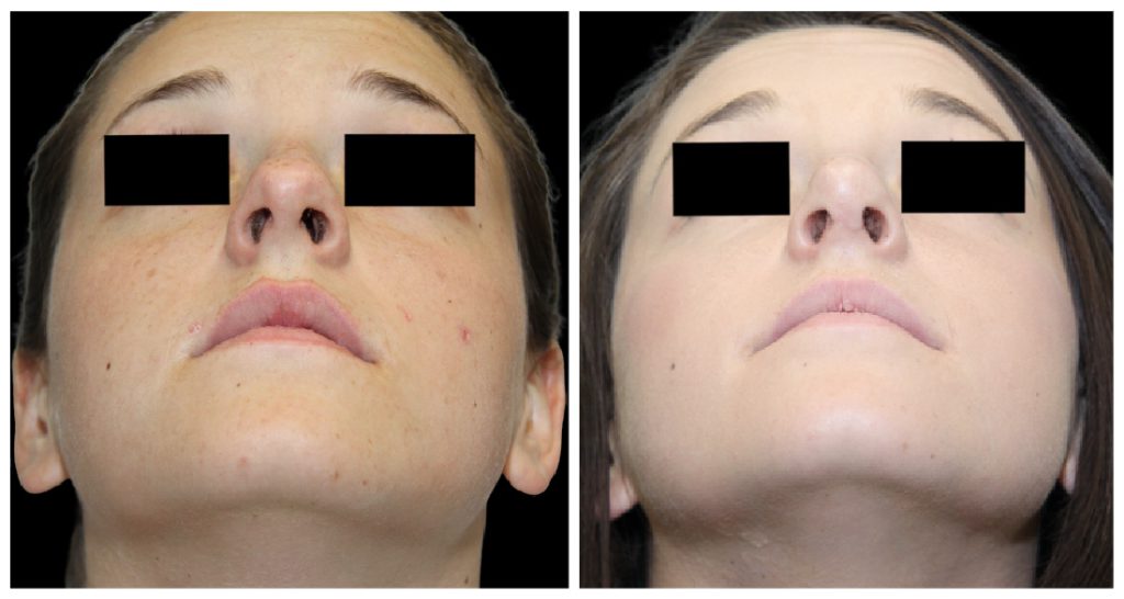 Before and after images of a patient's nose, showing changes in shape and appearance following a rhinoplasty procedure.