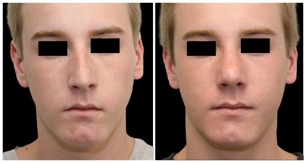 Before and after images of a rhinoplasty procedure showing changes in the nasal structure and facial profile of a male patient.